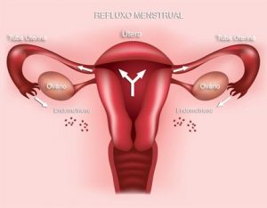 Endometriose: Refluxo Menstrual