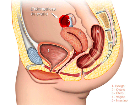 Menstruação com coágulos e endometriose: explorando a conexão